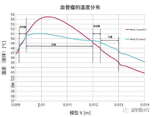 眼内肿瘤经瞳孔温热疗法的数值仿真