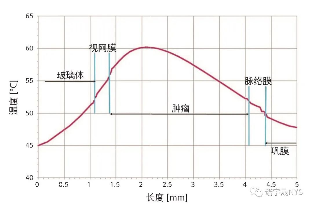 眼内肿瘤经瞳孔温热疗法的数值仿真